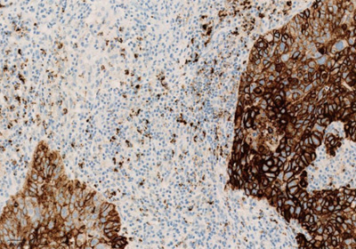 Окрашивание опухолевых и иммунокомпетентных клеток, инфильтрирующих опухоль, с помощью ИГХ-анализа VENTANA PD-L1