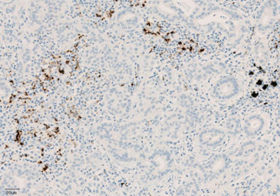 Окрашивание иммунокомпетентных клеток, инфильтрирующих опухоль, с помощью ИГХ-анализа VENTANA PD-L1 (SP142)